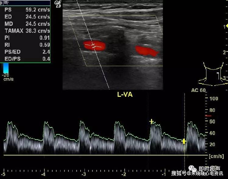 正常椎动脉彩色多普勒血流图彩色血流信号充盈于管腔内,其血流方向