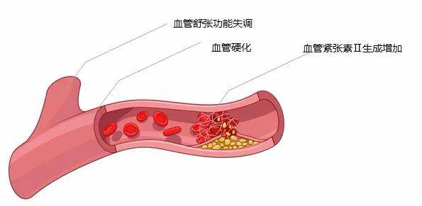 大家可以想一想这个画面:血管阻力高了,血管还被紧张素收缩了,那么