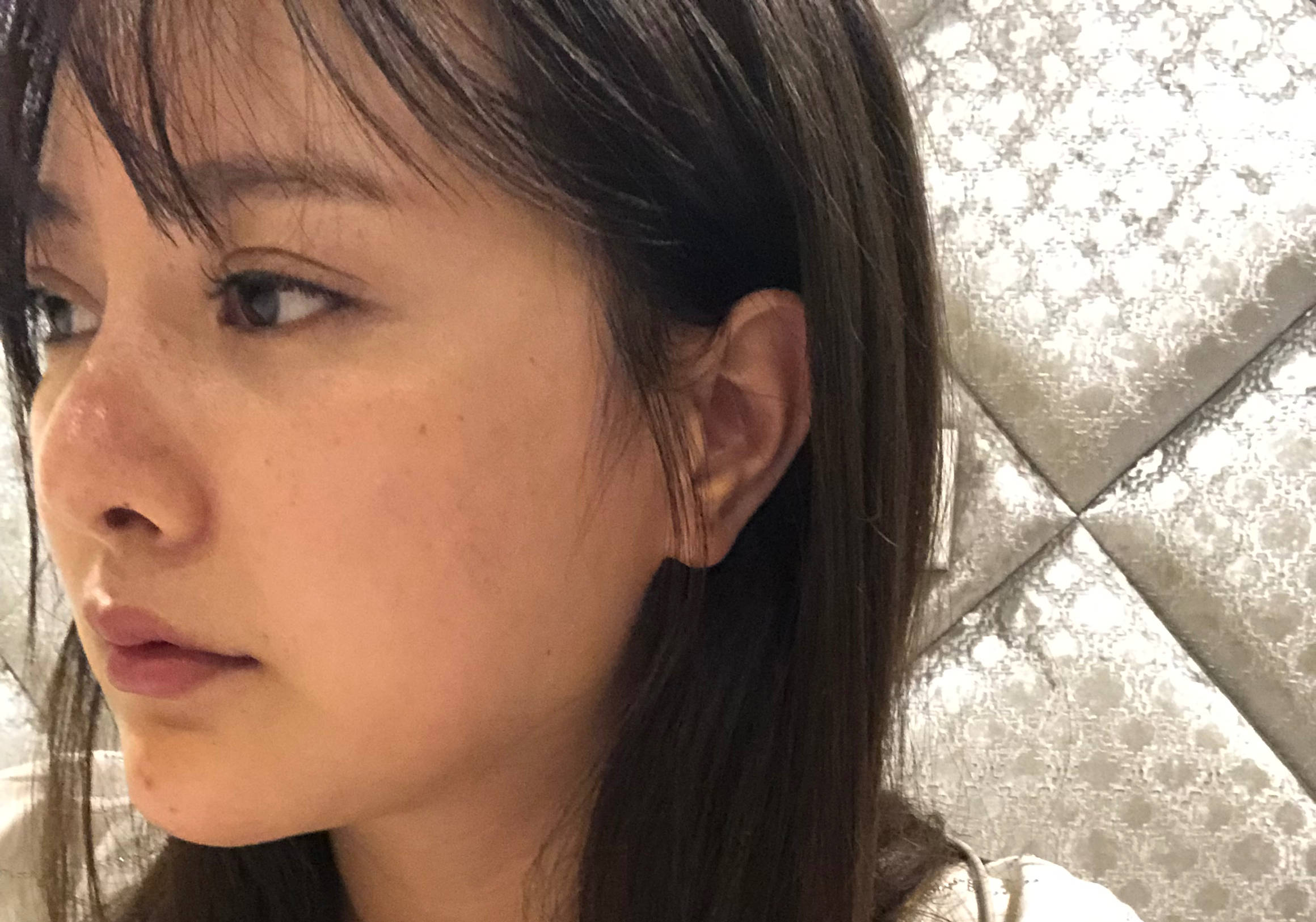 之前我在其他机构做了硅胶假体 单耳软骨隆鼻, 做完拆了夹板之后,我
