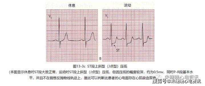 第十三讲:st段改变与心肌缺血1