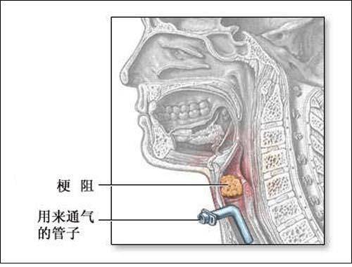 原创家属担心的割喉叫气管切开医生提醒8类人要做并不危险