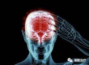 老年痴呆症|老年痴呆症病因有哪些