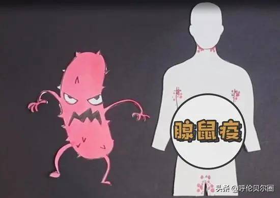 鼠疫的症状 来自搜狐网