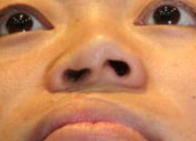 兔唇案例讲解二:唇裂术后唇鼻继发畸形表现及修复方法