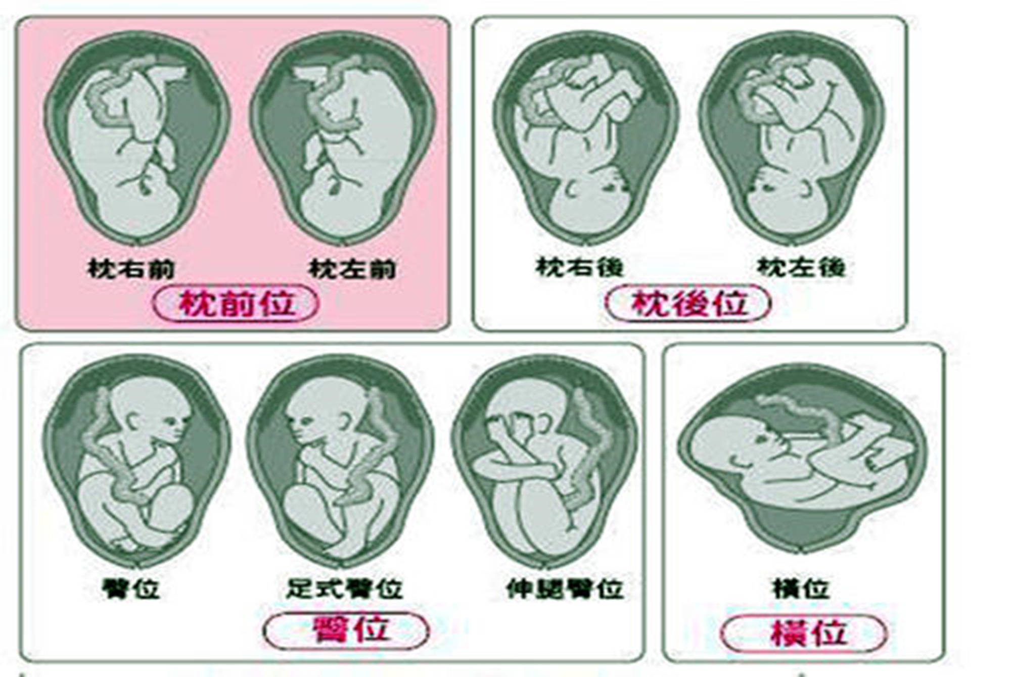 可以顺产的胎位 头位——头部朝下,臀部朝上 如果你的b超单子上写的是