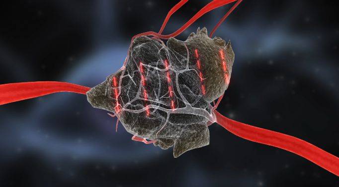 小粒子大能量,带你了解碘125粒子植入治疗肿瘤