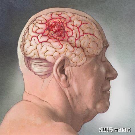 原创脑胶质瘤鉴别诊断基础简介