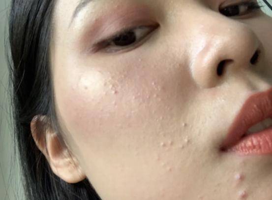 堵在了毛孔里面,所以就会导致我我们的皮肤状态越来越差,被堵塞的毛孔