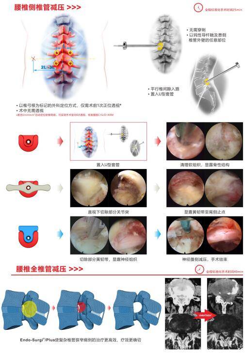 廣漢首例!外科手術內鏡化治療腰椎間盤突出症