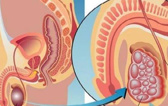 睾丸积液不治行吗都给你整清楚了