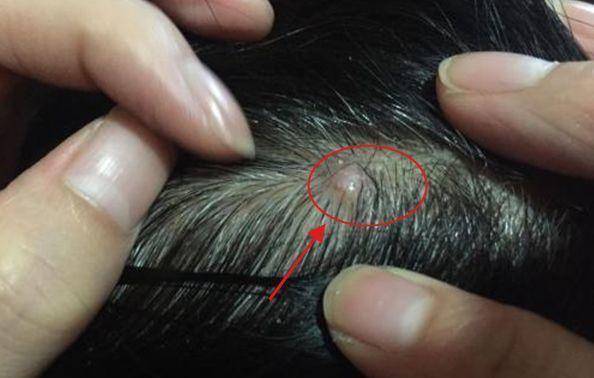 头皮里的小疙瘩是什么可能已经被这3种病缠上身无视后悔