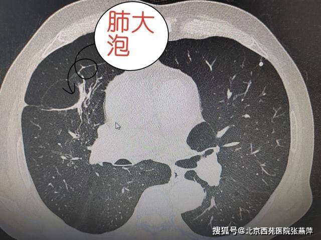肺大泡是什么病严重吗图片