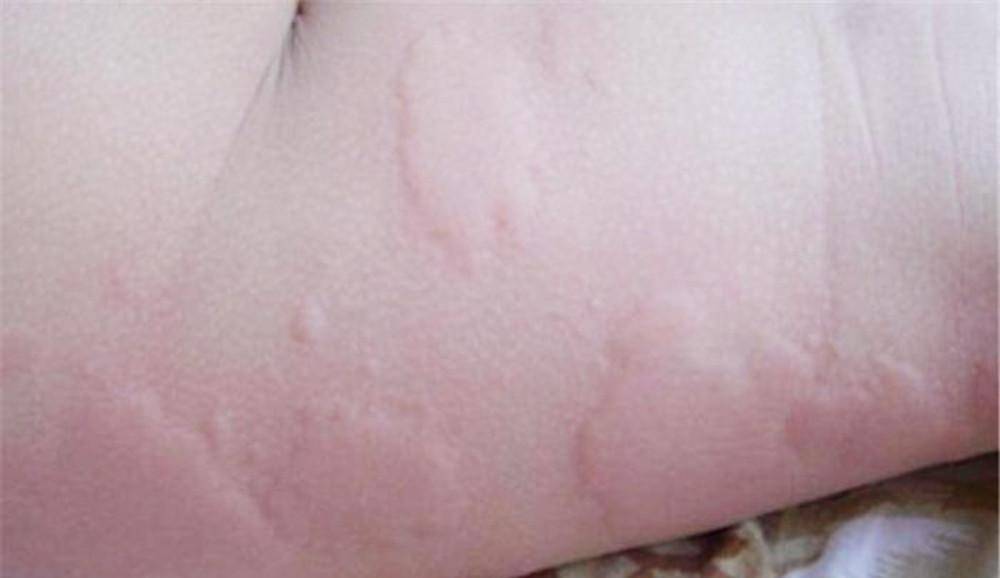 4岁女儿身上起红疹,反复治疗没疗效,掀开床单宝妈忍不住打哆嗦