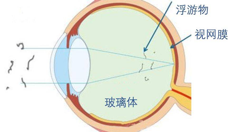 眼睛玻璃体位置图片