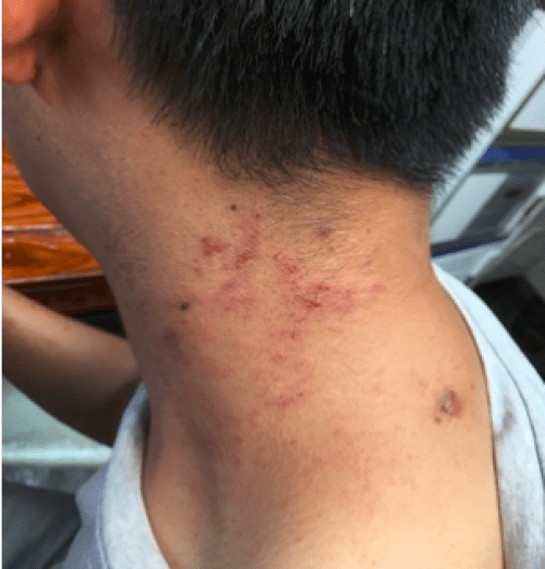 江纶忠治疗湿疹的简单方法10多年的老患者教你如何战胜湿疹