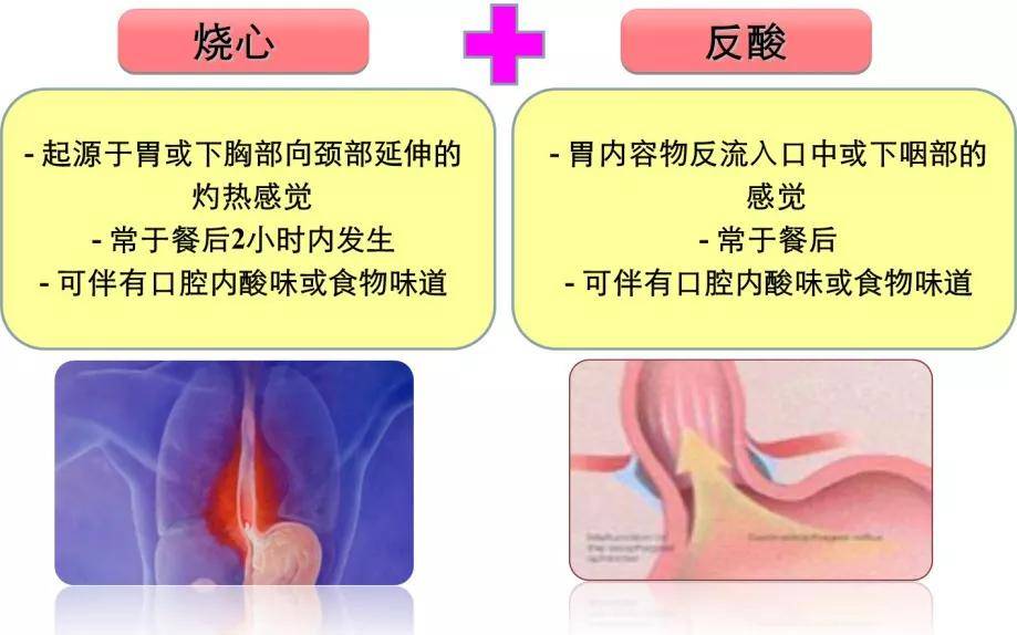 胃食管反流病,能完全治癒嗎?