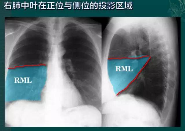 右肺下叶在正位与侧位的投影区域