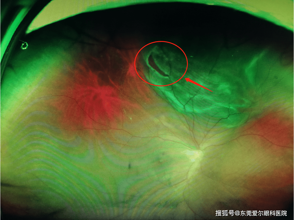 视网膜脱离"经过全面的眼底检查后(视力下降,闪光感,黑影遮挡)眼前