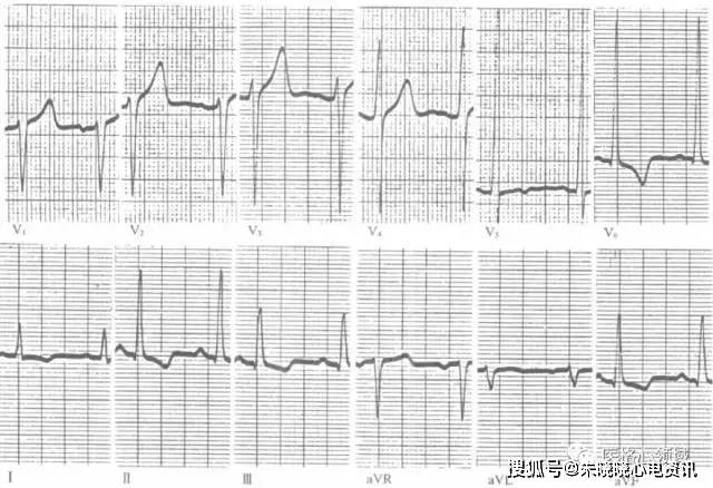 1, qrs波群高电压:rv5或rv6>2.5mv,rv5或rv6 sv1>4.0mv(男性)或>3.