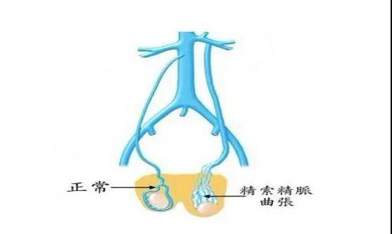 精索靜脈曲張是由於包繞精索的精索靜脈和蔓狀靜脈