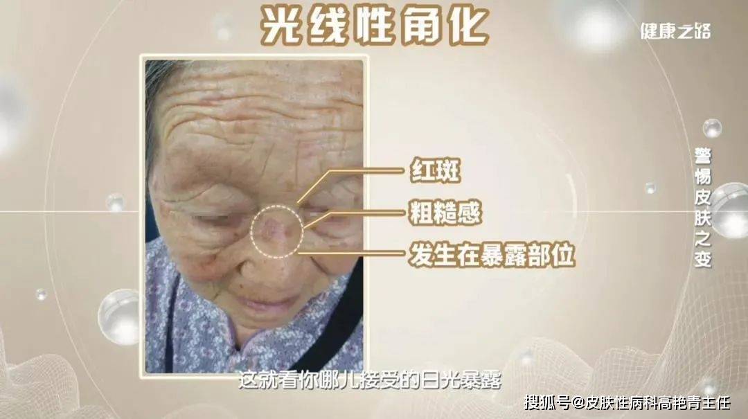 快来看看高主任的专业分析! 日光性角化