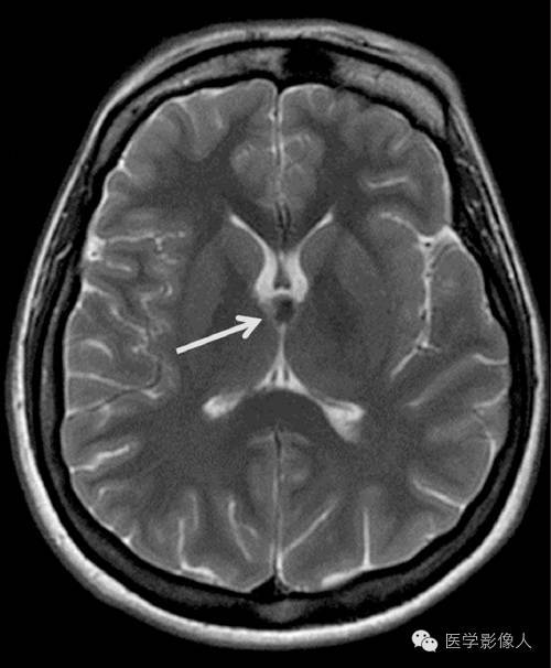 8大类脑内t2wi低信号病变