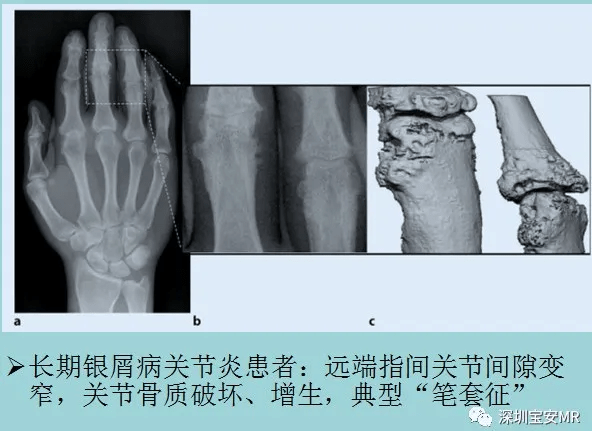 1,手:遠端指間關節多見,早期僅關節周圍軟組織腫脹,局部骨密度減低.