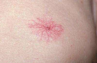 肝病早期会出现7个症状3个部位会变黄4个地方会变红