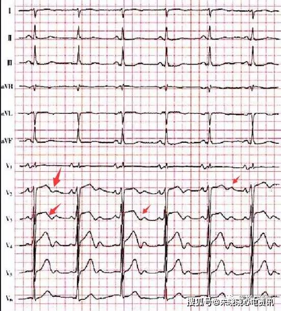 有定论,但是由于异常病理性u波的出现,人体一些心血管疾病可以被发现