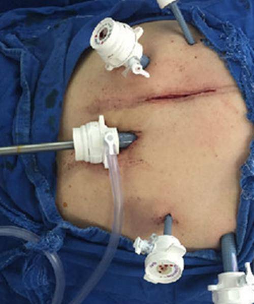 肝硬化腹水的3个治疗准则你知道是哪些吗