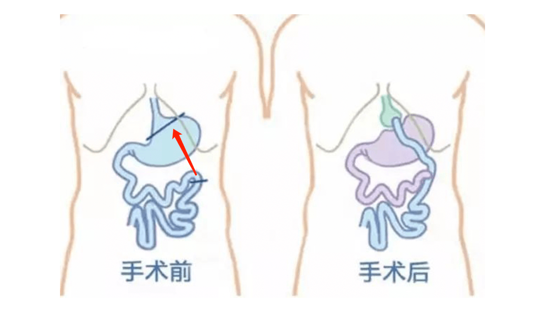 知名經紀人公開做切胃手術沒有胃怎麼進食這就告訴你