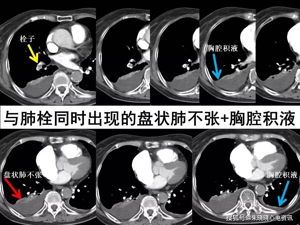 肺栓塞 ct 不會讀?看完這篇文章輕鬆入門!