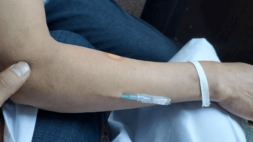 针灸说 | 浮针疗法_手机搜狐网