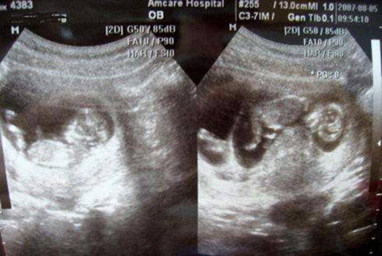 一个孕囊双胞胎彩超图图片