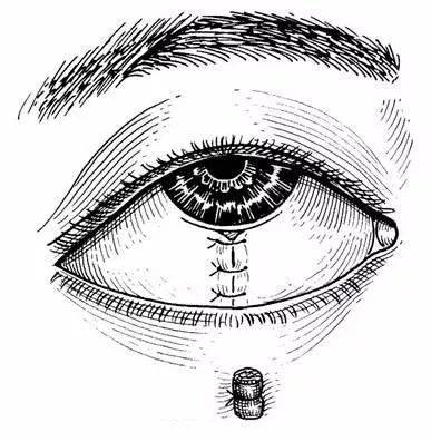 眼睛干眼,干涩,异物感;中老年人最常见需注意可能是得了这种病_结膜