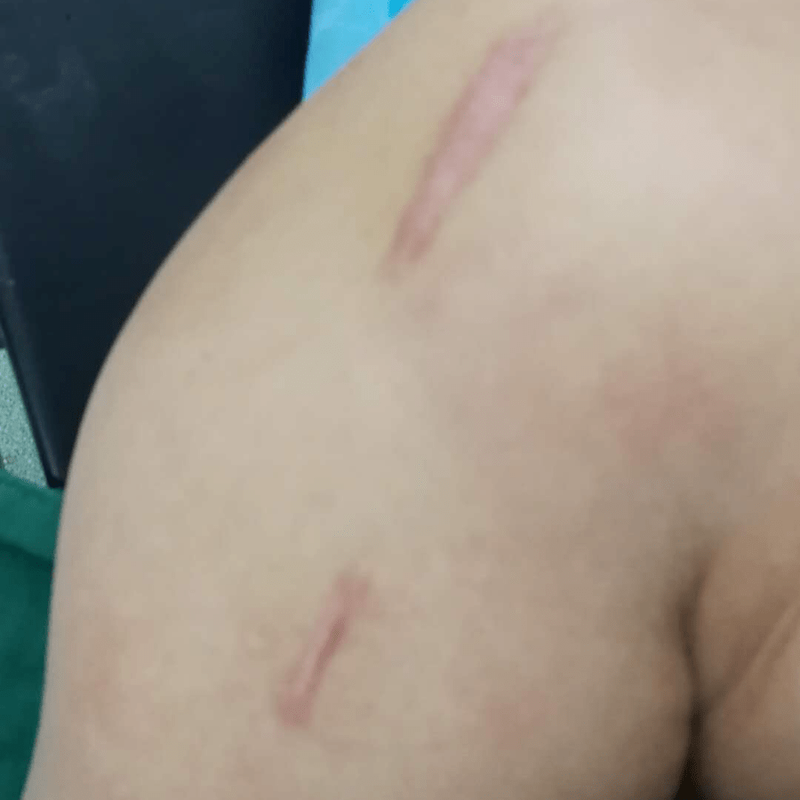 胡医生|【杭州城东医院丨案例】“新技术”为“肱骨近端粉碎骨折”患者复原