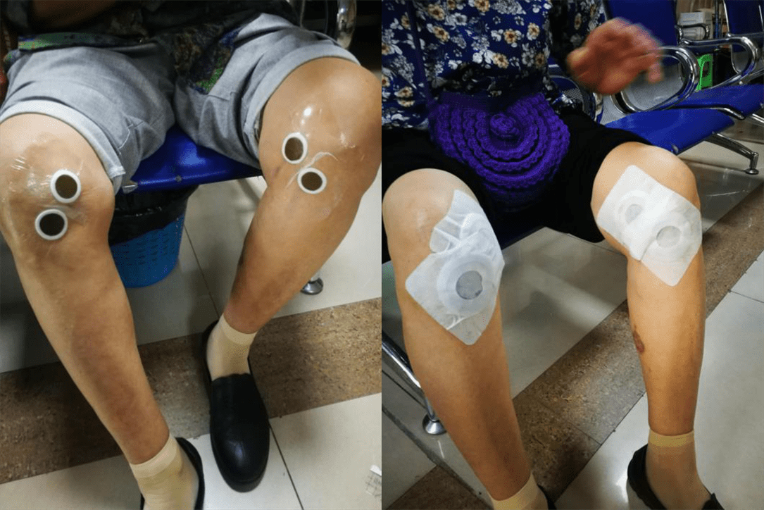 膝关节疼痛久治不愈?别怕!用这个疗法见效快,痛苦少,还你健康膝盖!