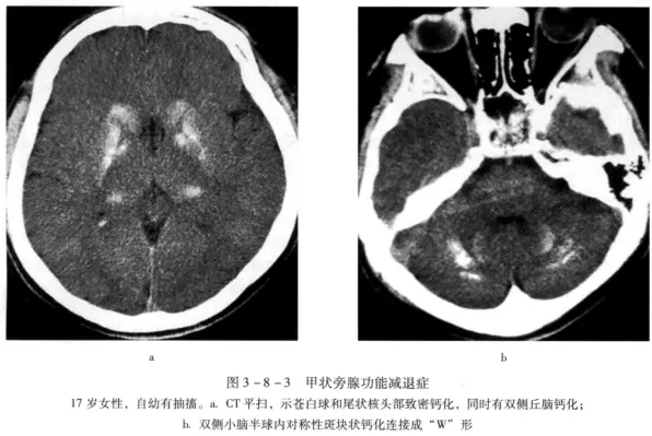 头颅 ct 表现主要表现为 颅内对称斑块状钙化,在基底节,小脑齿状核呈