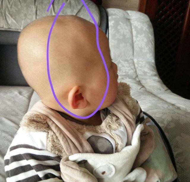 3种睡姿影响孩子头骨形状,大脑发育也会受限,别再让娃这样睡了