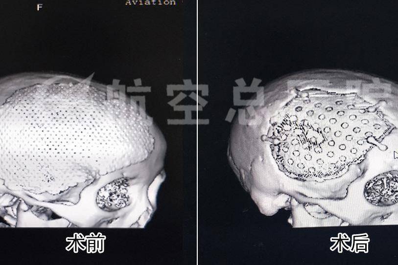 顱骨修補鈦網顱骨使用期限