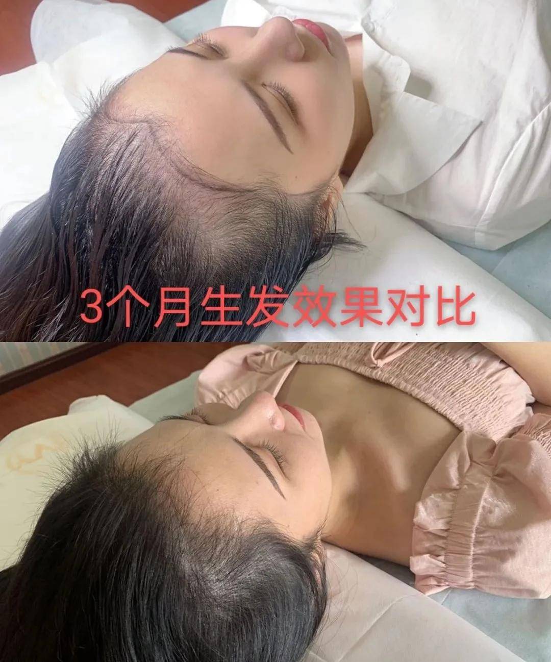 技能|别再问了！柏芮拉再生发逆龄术不是纹发，更不是植发！