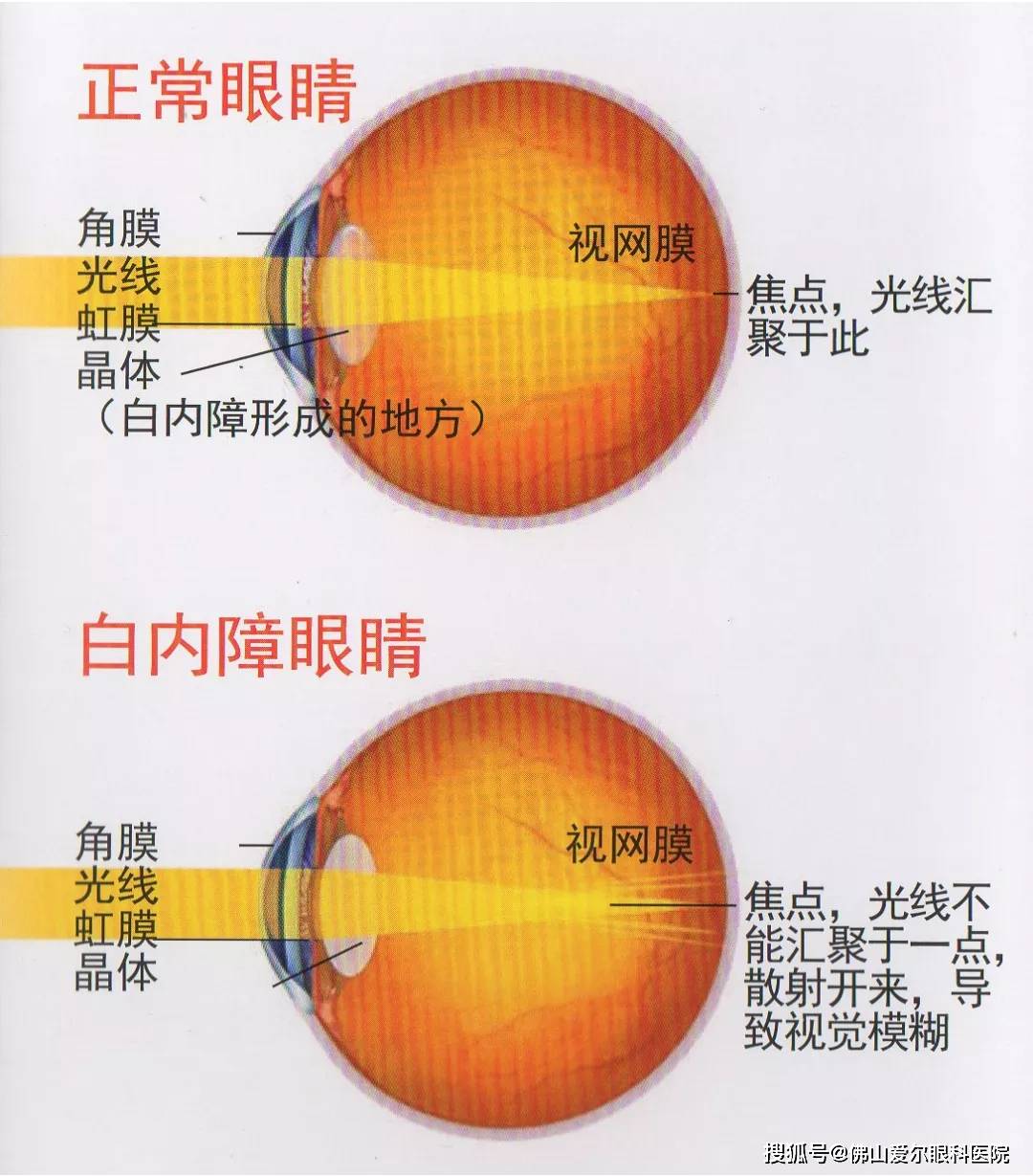 如何判断是白内障图片图片