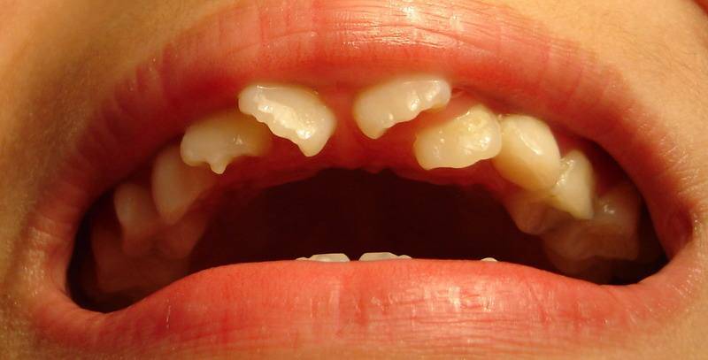 牙齿中央尖畸形图片