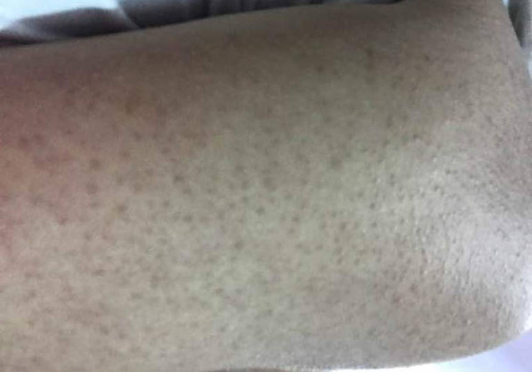 鸡皮肤毛发倒生长在皮肤里(鸡皮肤毛发倒生长在皮肤里怎么回事)