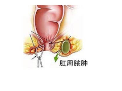 肛周膿腫你瞭解多少