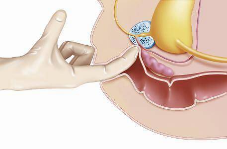 檢查前列腺疾病時要做肛診和前列腺按摩嗎怎樣做
