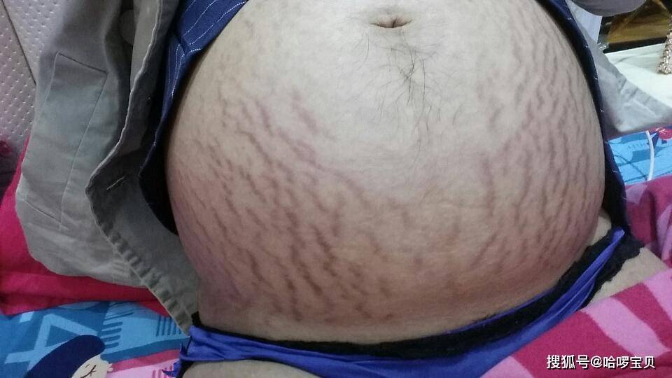 不想产后肚子变西瓜皮预防妊娠纹不同阶段方法不一样
