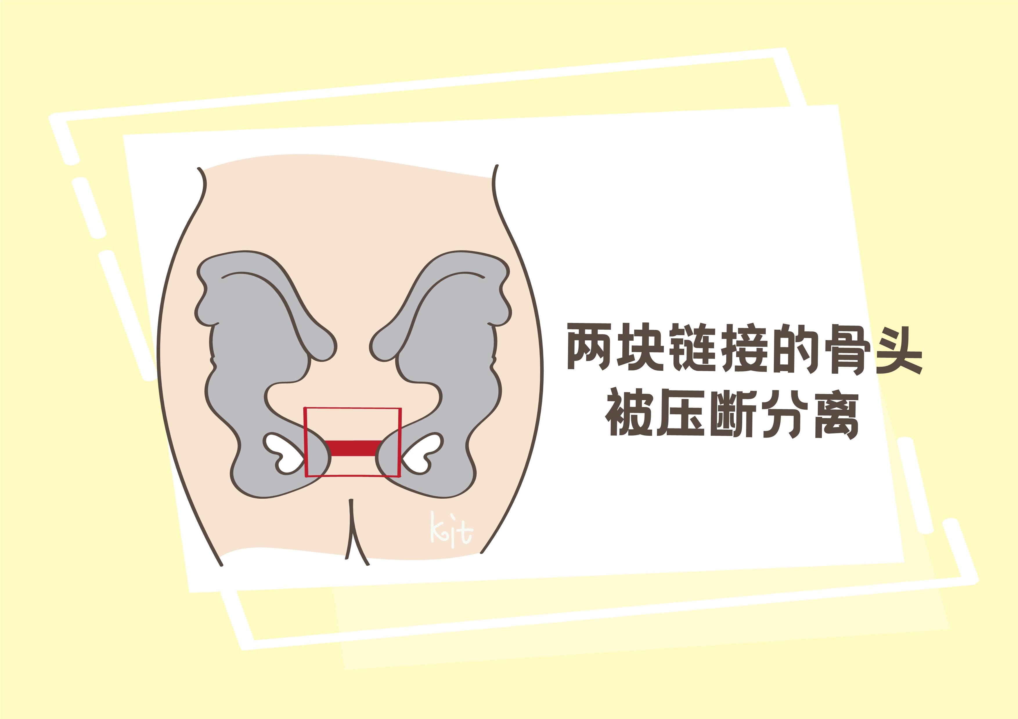 孕早期耻骨痛图片
