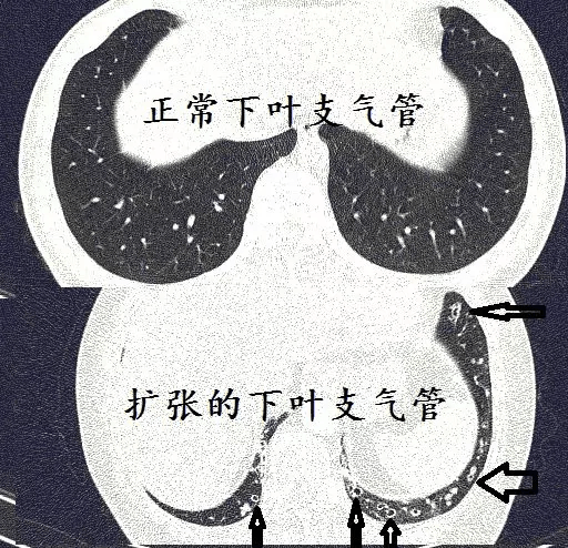 收藏详细解说ct诊断支气管扩张小诀窍