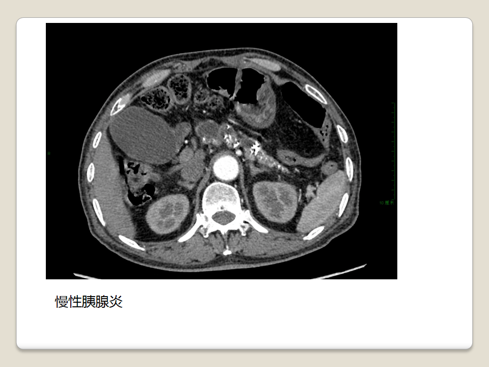 胰腺常見囊性腫瘤的ct表現及鑑別診斷